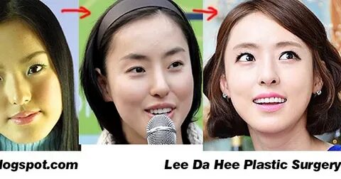 Lee da hee plastic surgery - Plastic Surgery