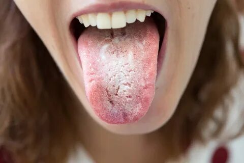 Oral candidiasis: causes, types and treatment - The Pharmace