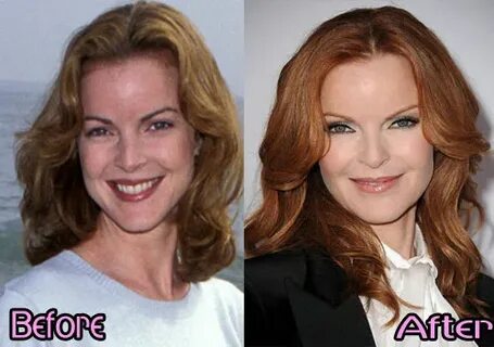 Marcia Cross Plastic Surgery Before and After Bad Plastic Su