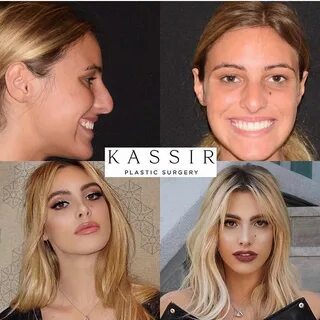 Plastic Surgeon Dr. Kassir ™ в Instagram: "Happy 24th birthd