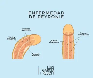 Enfermedad de Peyronie - Clínicas García Reboll