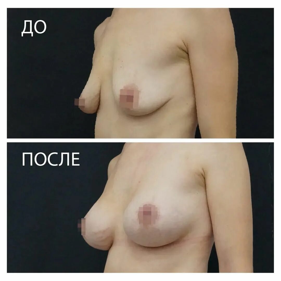 массаж для увеличении грудью фото 116