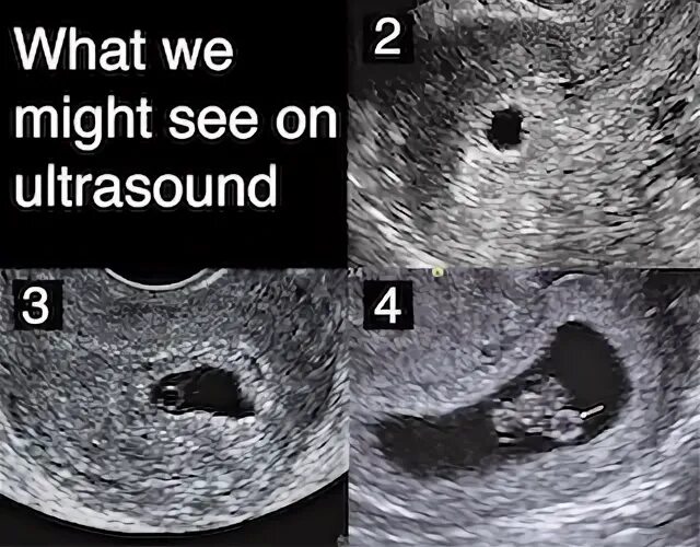 6 Week Vs 8 Week Ultrasound : For this reason, some people c