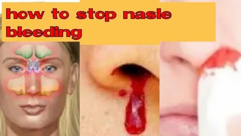 nose bleed cause & prevention nasal bleeding irha informativ
