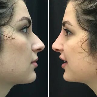 Non-Surgical Rhinoplasty Photos Usha Rajagopal, MD