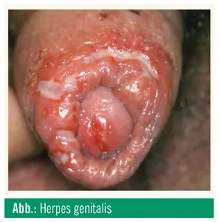 Herpes primärinfektion