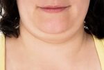 FDA Staff Backs Injection To Reduce Double Chin