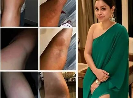 sumona chakravarti gets bruised and blotched see pics - I am