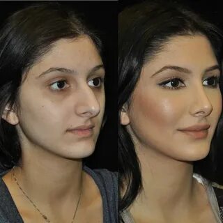One of our beautiful patients before and after #rhinoplasty 