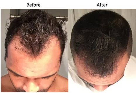 Saw Palmetto For Women S Hair Loss - Best Images Hight Quali