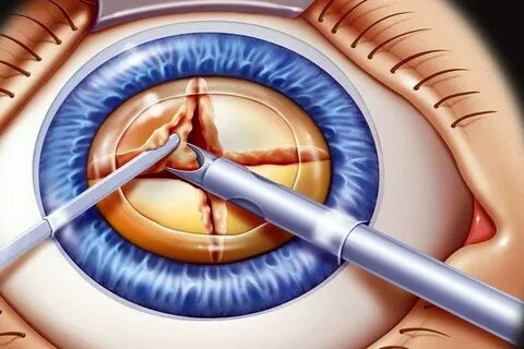 What to Expect With Cataract Surgery Cataract surgery, Catar