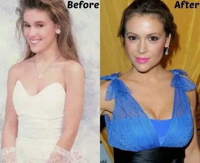 Alyssa Milano Breast Implants