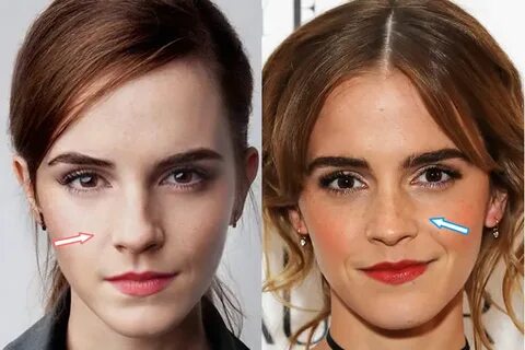 Emma Watson Cosmetic Surgery - Nose Job, Teeth & Breast Impl