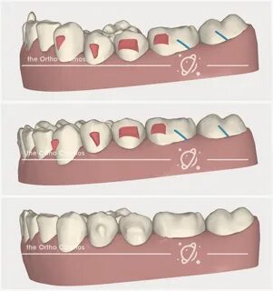 Posterior Openbites with Aligners - The Ortho Cosmos