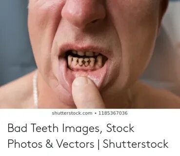 Shutterstockcom 1185367036 Bad Teeth Images Stock Photos & V