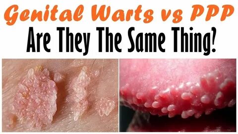 Genital Warts vs PPP - Are They The Same Thing Here Is The T