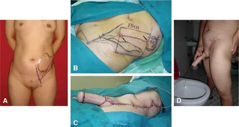 Scrotal Reconstruction In Ftm Transsexuals - Visitromagna.ne