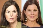Marcia Gay Harden Plastic Surgery - Plastic Industry In The 