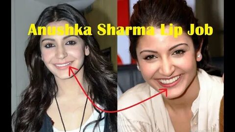 Anushka Sharma Plastic Surgery Before After DISASTER !! - Yo