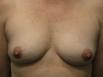 An Uncommon Form of Breast Revision: Permanent Breast Implan