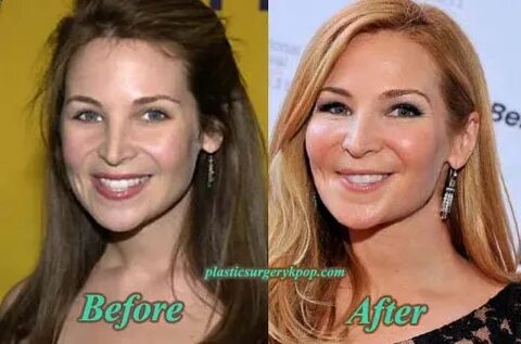 Jennifer Westfeldt Plastic Surgery Before and After