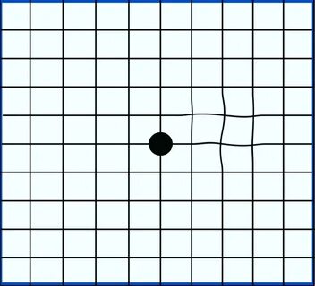 An Amsler grid showing mild distortion. Loose lips sink ship