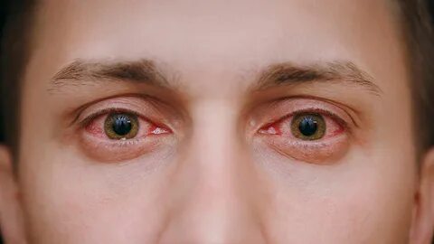 23 Causes and Treatments for Red Eyes Pink eyes, What is pin