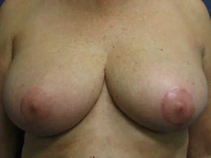 Example of the appearance of the nipple-areola complexes following a free n...