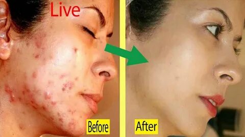 Treatment Of Pimples And Acne With Disprin Tablets - YouTube