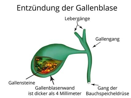 Cholezystitis und Cholangitis (Gallenblasenentzündung, Gallenwegsentzündung)