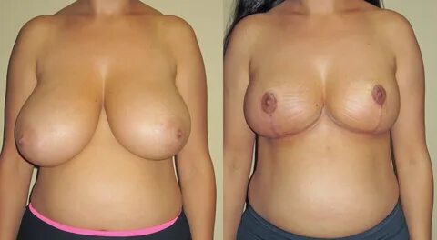 Bilateral Breast Reduction.