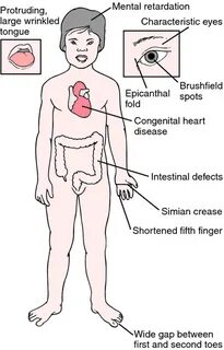 Pin on Down Syndrome