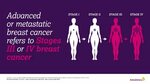 Metastatic Breast Cancer (MBC) is the most advanced stage of