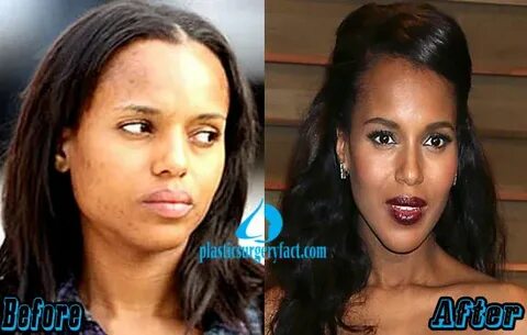 Kerry Washington Plastic Surgery Before and After Photos - P