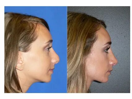 Can A Nose Job Fix A Wide Nose - Inspiration Guide