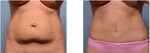 Tummy Tuck Or Related Keywords & Suggestions - Tummy Tuck Or