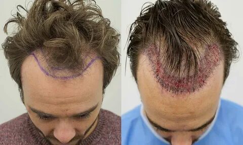 Is Hair Transplant Permanent? + Hair transplant images GOMED