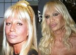 Donatella Versace Plastic Surgery Before and After Photos Ce