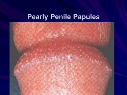 Human Papillomavirus (HPV) - ppt download