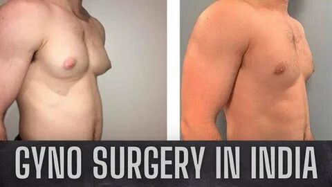 ...india, gynecomastia, signs, symptoms, cosmetic surgeon, gynecomastia sur...