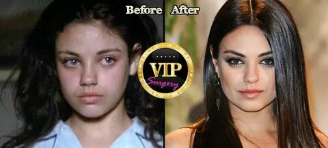 Mila Kunis Nose Job Before and After Photos