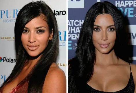 kim-kardashian-before-and-after-plastic-surgery - Claudia an