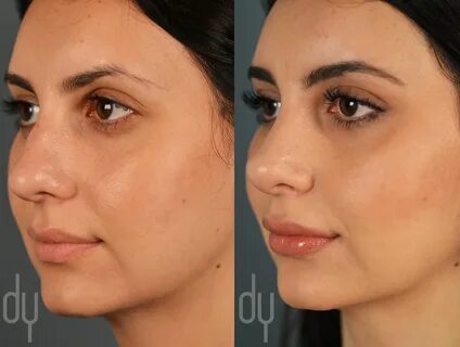 How To Fix A Crooked Nose Non Surgical - How To Best Service