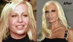 Donatella Versace Plastic Surgery Before and After Photo Cel