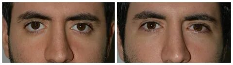 Young male with congenital rounded eyes and bottom eyelid re