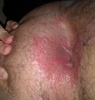 Yeast infection porn xxx - Pic Porn