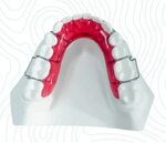 hawley-retainer-6 China Orthodontic