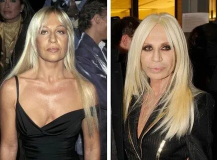 Donatella Versace Before & After Plastic Surgery Donatella v
