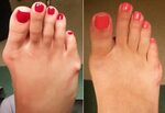Bunion Picture Pre Op and Post Op 3 months after surgery - O