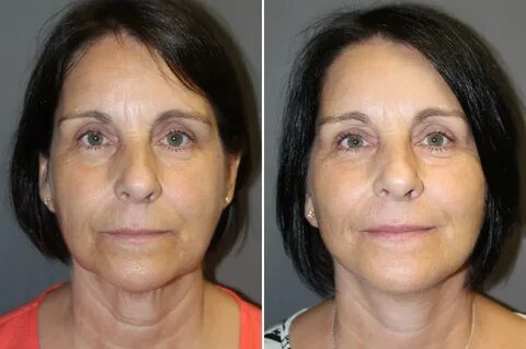 Natural Surgical Facelift pictures Boston, MA Patient 10347
